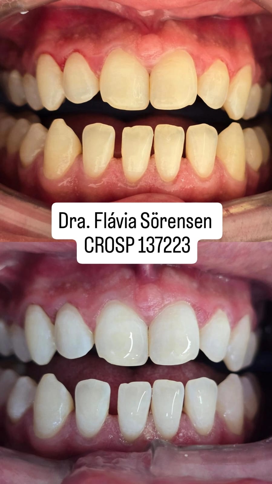 Antes e depois do tratamento - Caso real